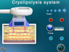 cryo handle cryolipolysis only best cryolipolysis machine TM-920