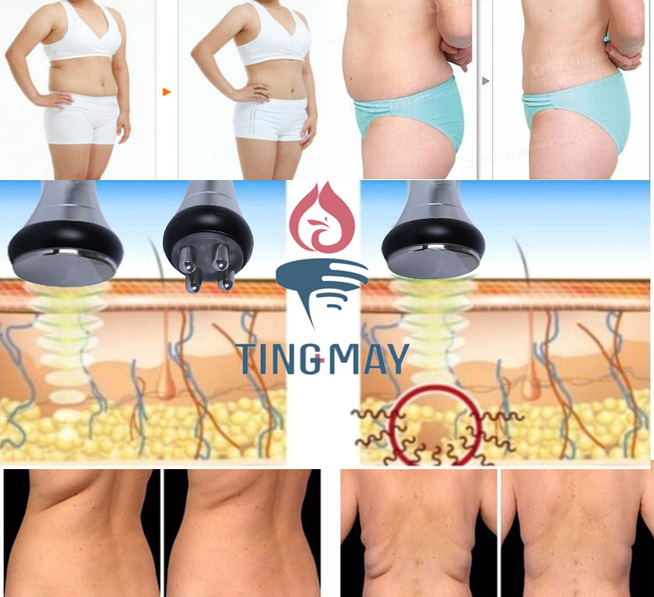 Portable vacuum cavitation lipo laser weight loss rf skin rejuvenation machine TM-660D