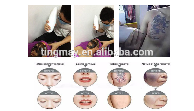 China manufacturer q switch nd yag laser tattoo removal machine